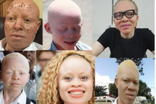 Albinism