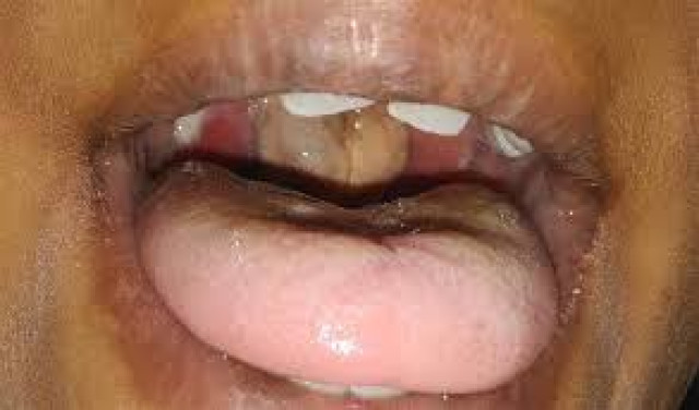 Diphtheria Disease