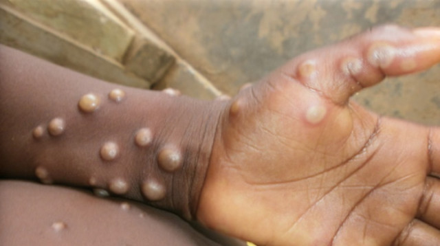 Photo of a hand with Swollen lymph nodes