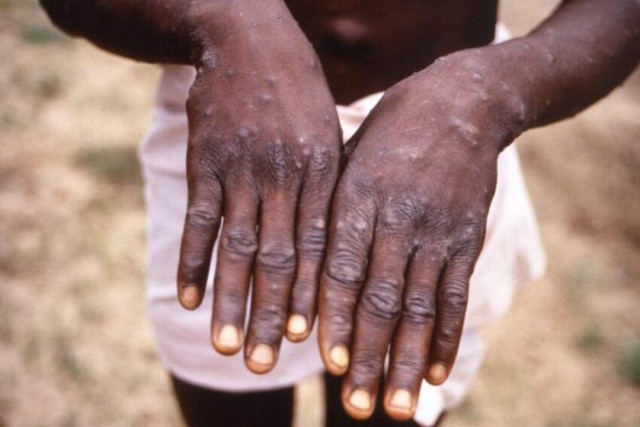 Picture indicating Mpox