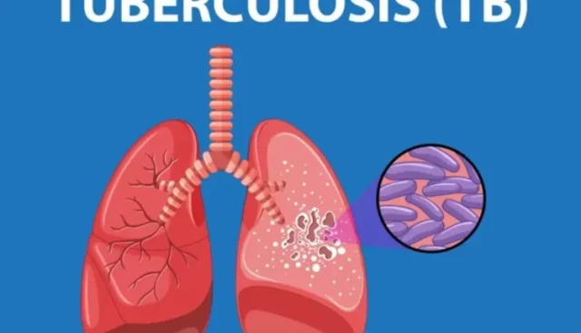 Picture illustration of Tuberculosis