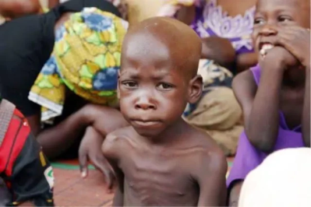 A child suffering from Malnutrition