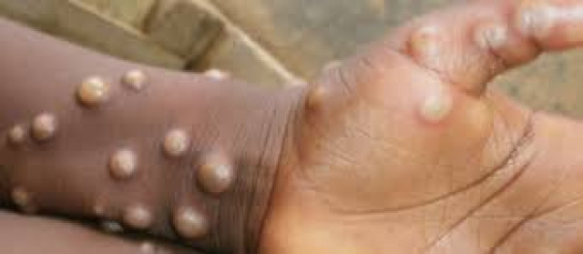 Mpox