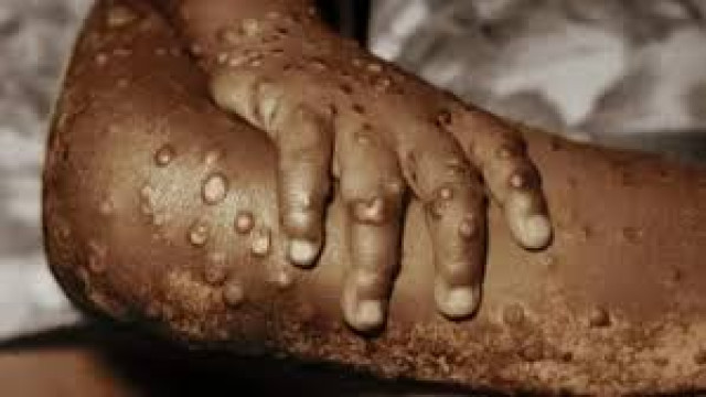 Mpox Disease